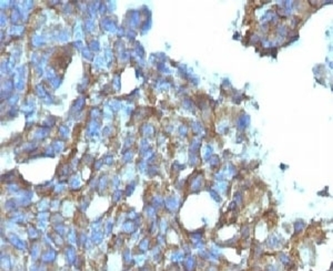 IHC testing of FFPE human ovarian carcinoma and CD99 antibody.