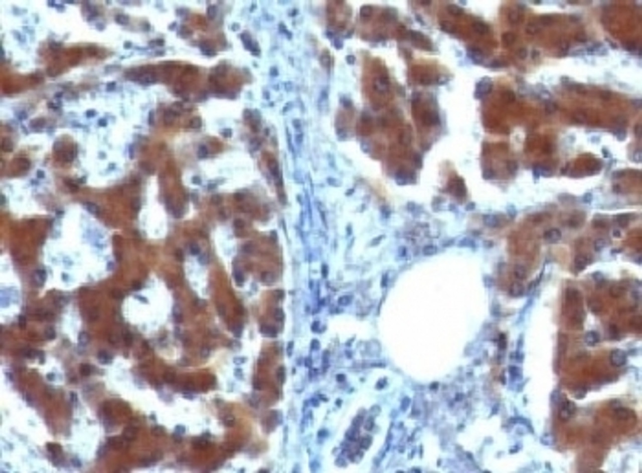 IHC testing of FFPE human hepatocellular carcinoma with RBP (clone RLBD1)