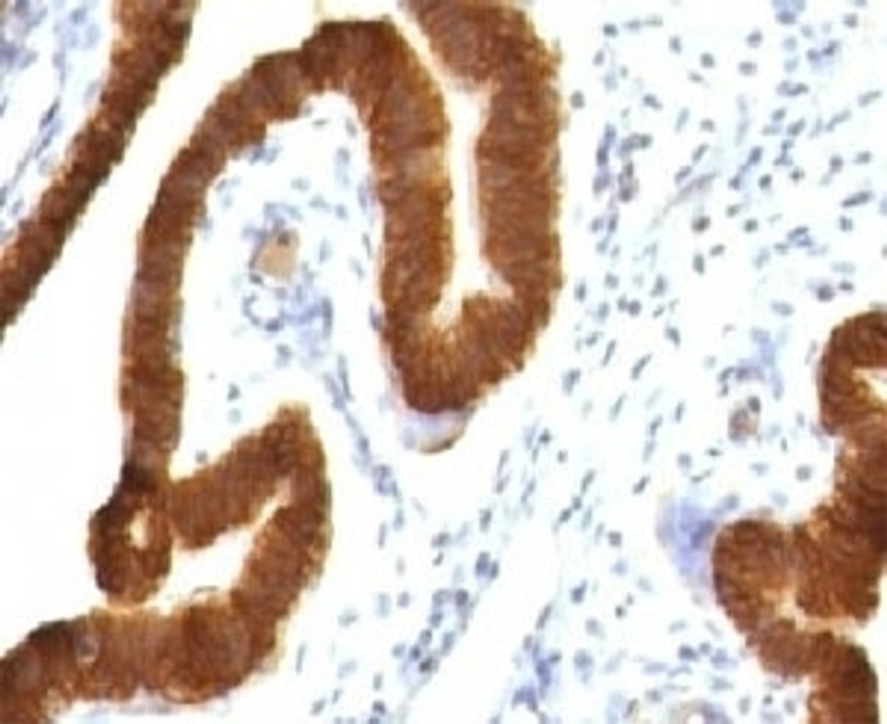 IHC testing of FFPE human ovarian carcinoma and Keratin 19 antibody.