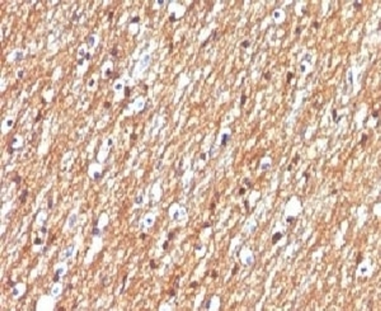 IHC testing of FFPE human brain tumor with CD56 antibody.