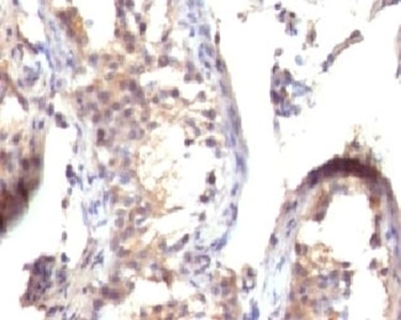 IHC testing of FFPE human testicular carcinoma with TGF alpha antibody (clone TFGFa-1)
