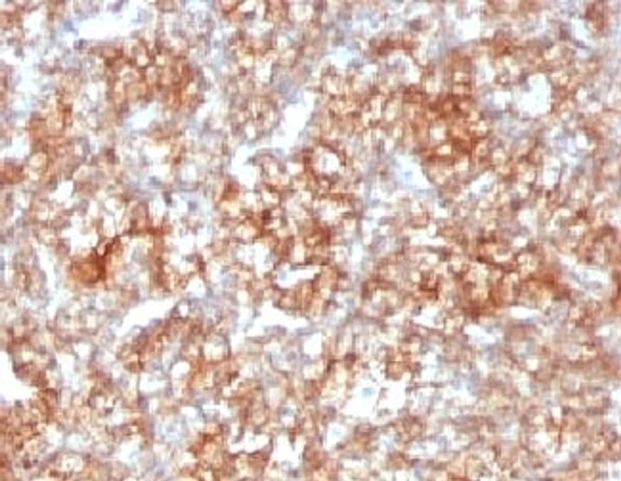 IHC testing of FFPE human renal cell carcinoma with CD147 antibody (clone CDLA147) .