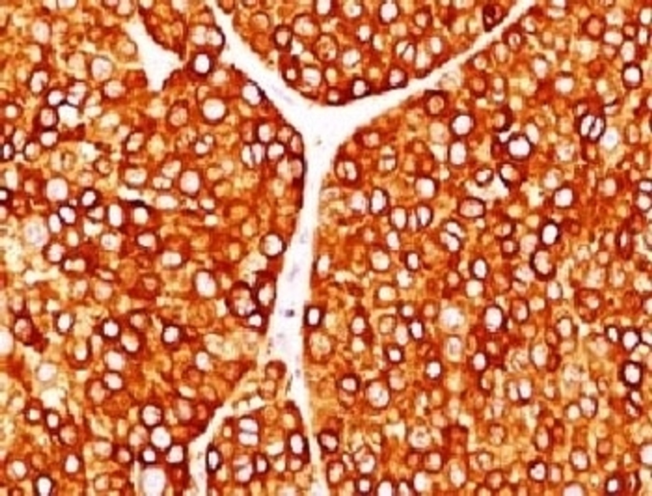 IHC testing of FFPE human melanoma with Tyrosinase antibody (clone TRSN1-1) .