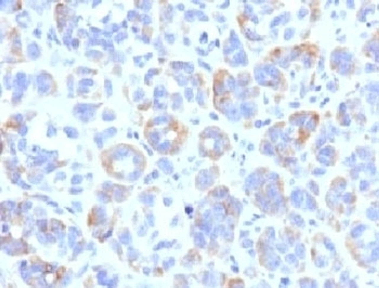 IHC testing of FFPE human melanoma with TRP1 antibody (clone TYRR1-1)
