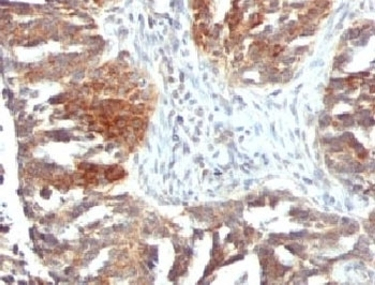 IHC testing of FFPE human ovarian carcinoma with VEGF antibody (clone VGFA-1) .