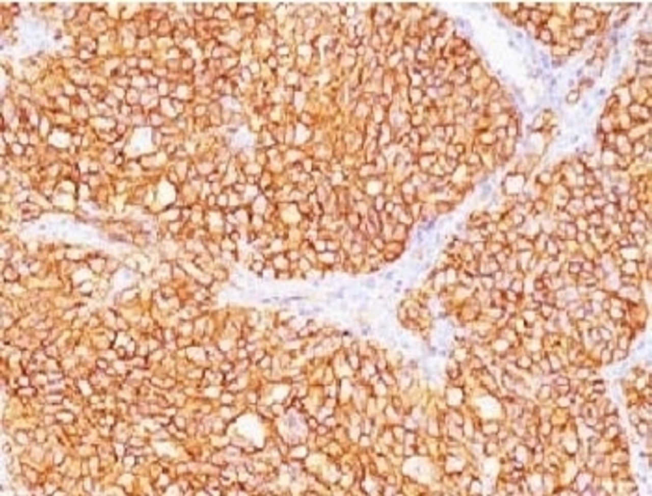 IHC testing of FFPE human renal cell carcinoma with CAIX antibody (clone CBAD9-1) .