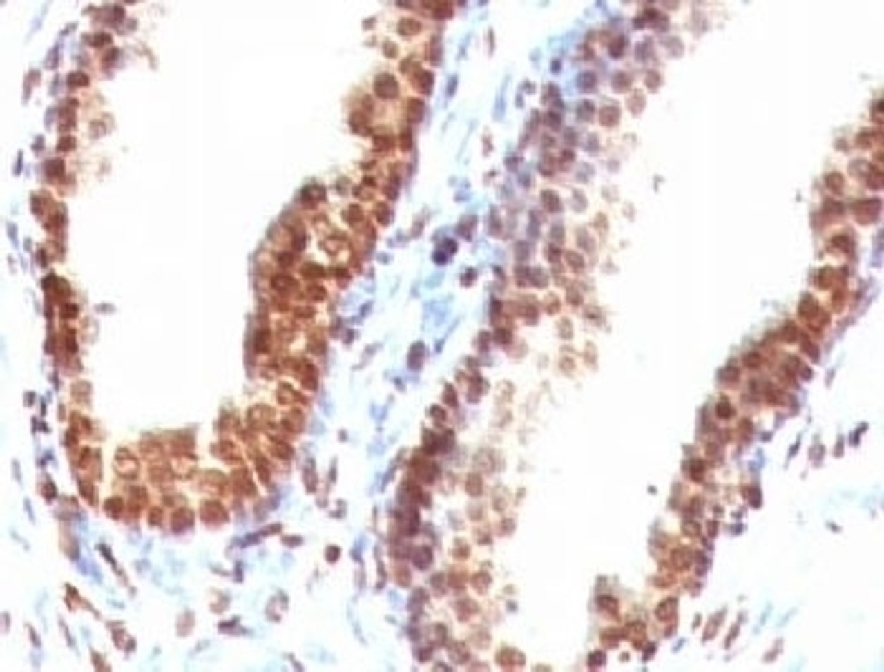 IHC testing of FFPE human colon carcinoma with dsDNA antibody