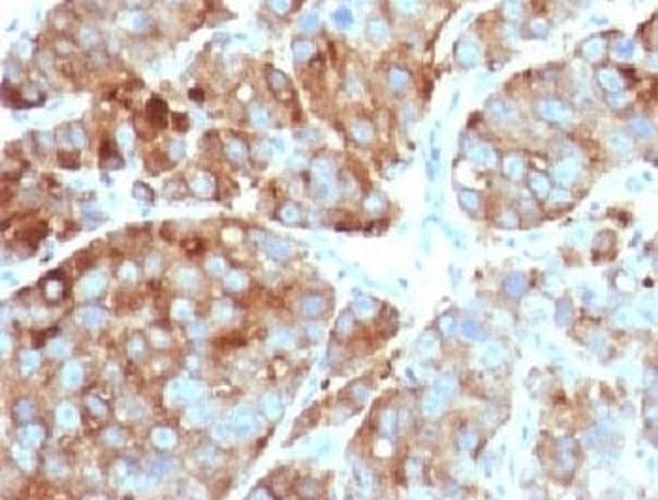 IHC testing of FFPE human prostate carcinoma with CD63 antibody.