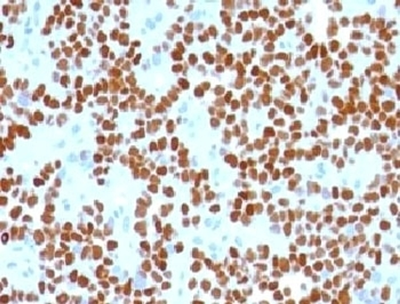 IHC testing of Ewing's sarcoma with NKX2.2 antibody.