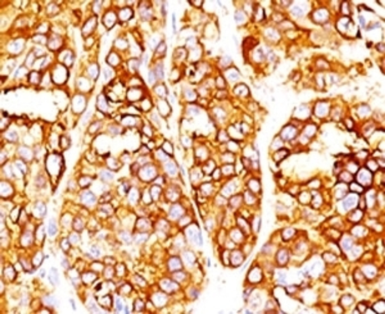 Formalin-fixed, paraffin-embedded human melanoma stained with MART-1 antibody (RMMRT1-1) .