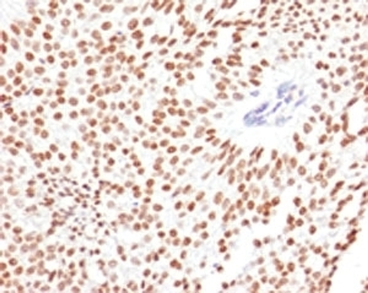 IHC testing of FFPE human bladder carcinoma with FOXA1 antibody.