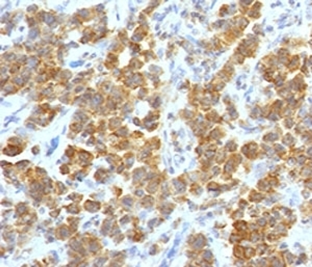 IHC testing of FFPE human parathyroid tumor with TL1A antibody (clone TLRM1-1) .