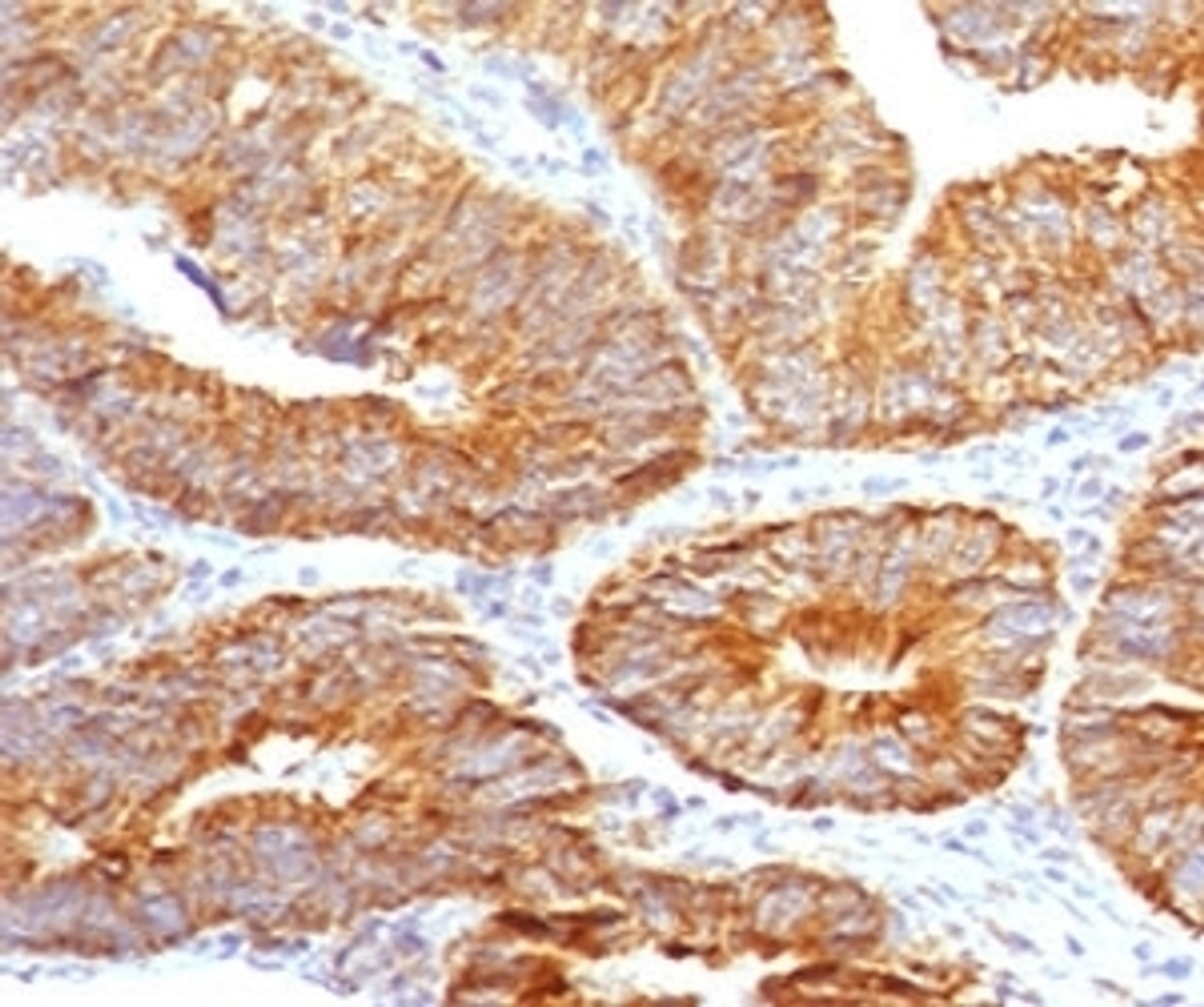 IHC testing of FFPE human colon carcinoma with TL1A antibody (clone TLRM1-1) .