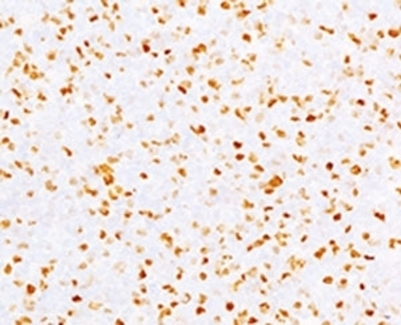 IHC testing of FFPE human bladder carcinoma with Topoisomerase II alpha antibody (clone TPM2A-2) .