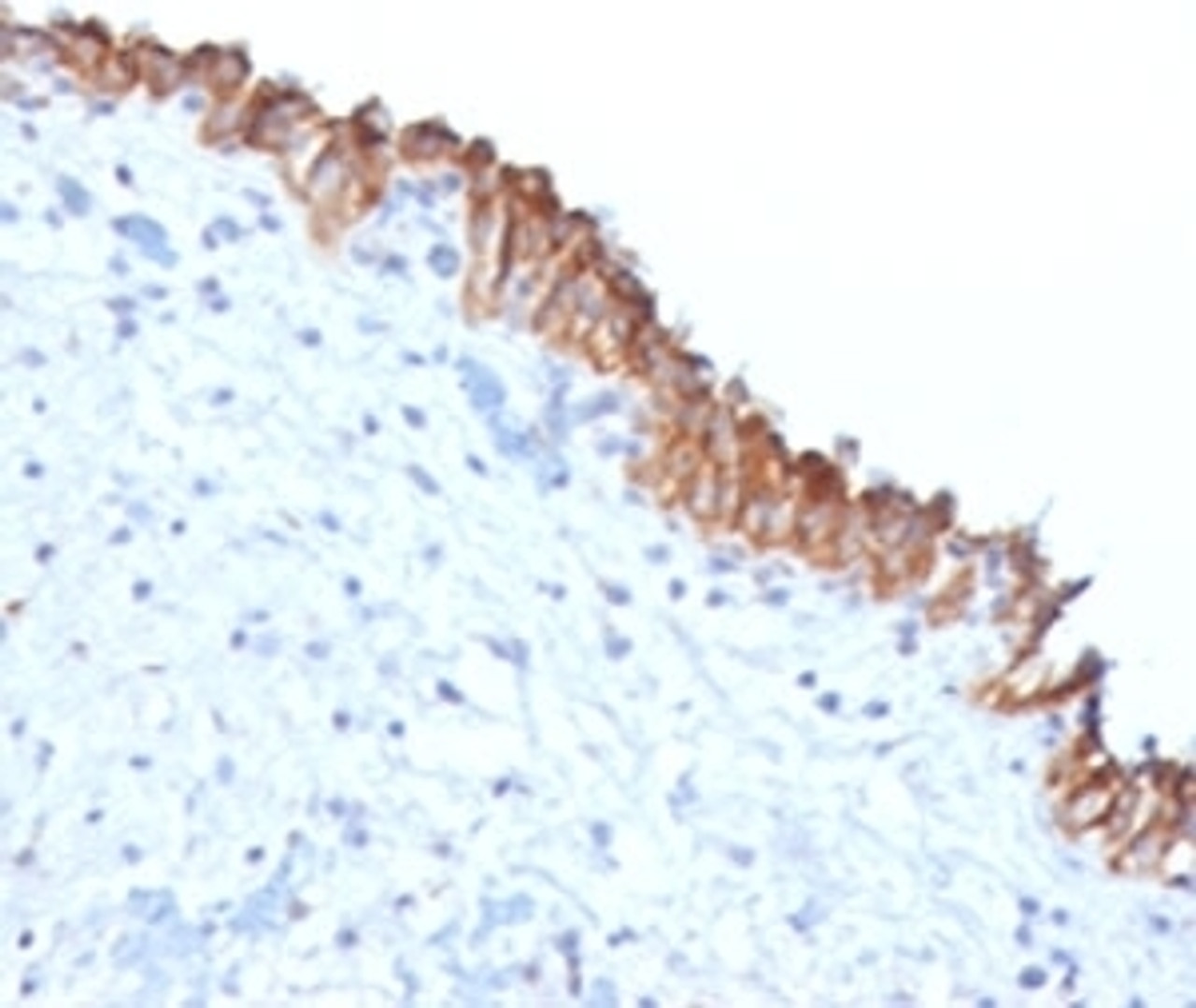 IHC testing of FFPE human bladder carcinoma with MAML2 antibody (clone MMLP2-1) .
