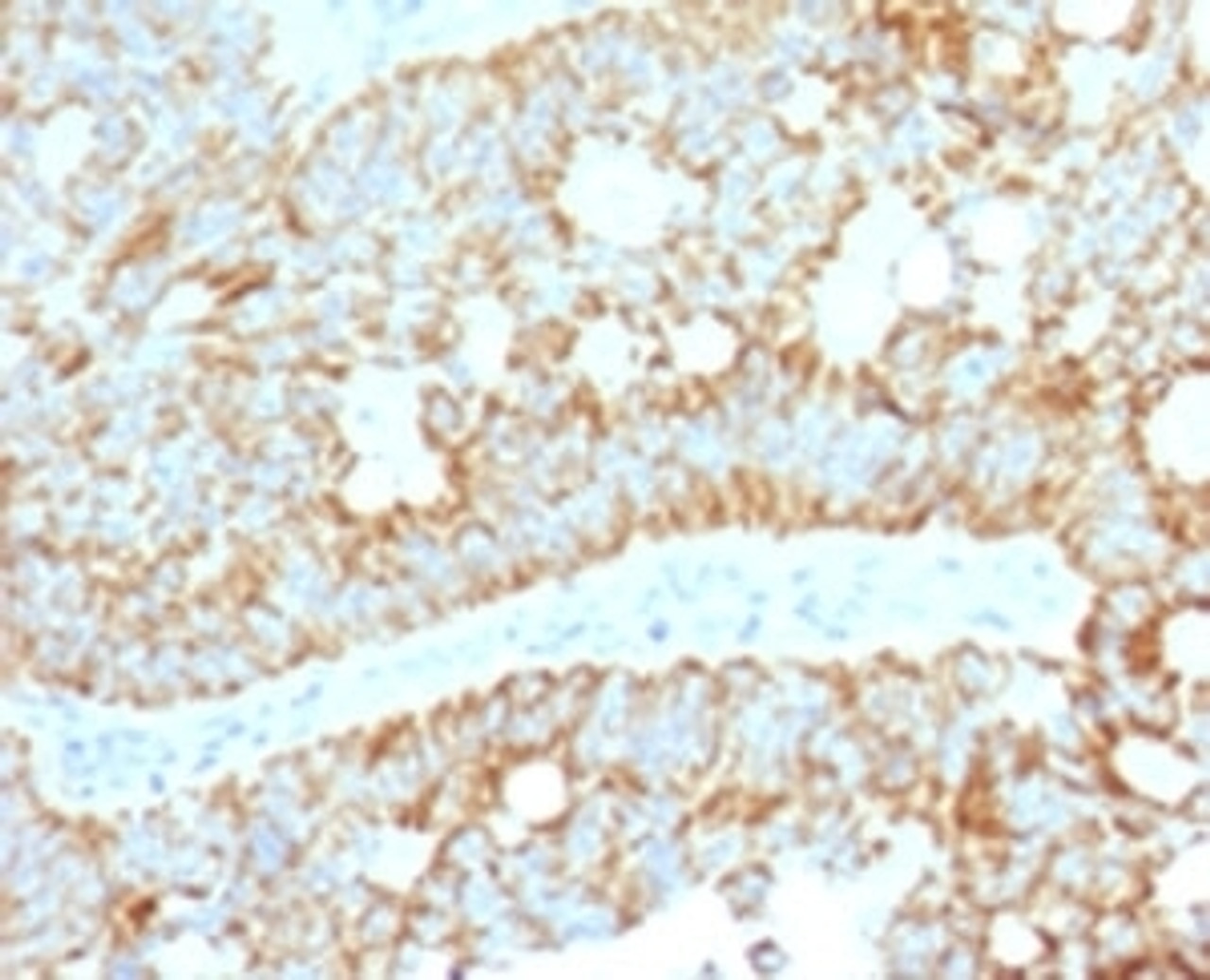 IHC testing of FFPE human colon carcinoma with MAML2 antibody (clone MMLP2-1) .