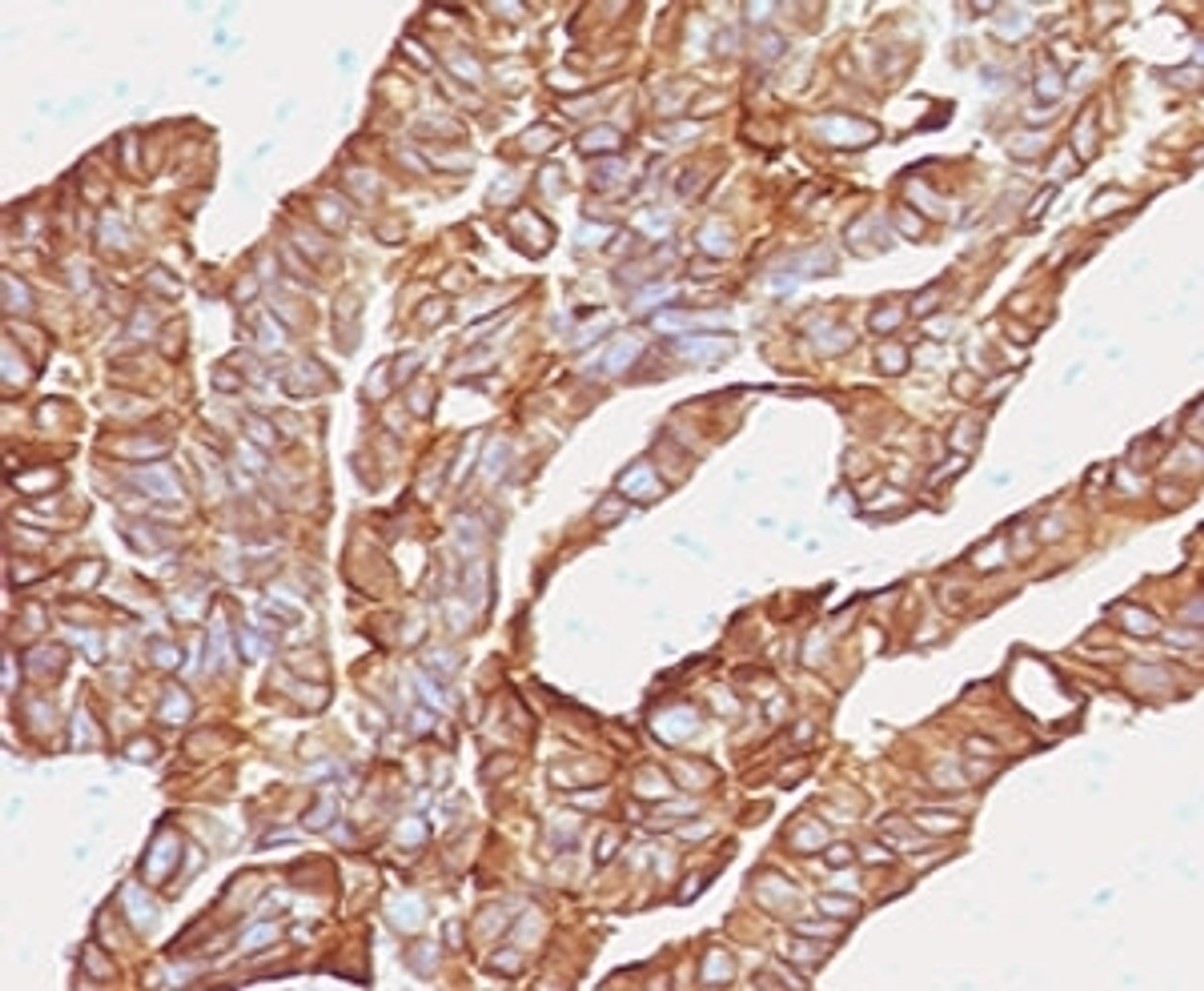 IHC testing of human colorectal carcinoma with anti-EpCAM antibody (clone EPM17-2) .