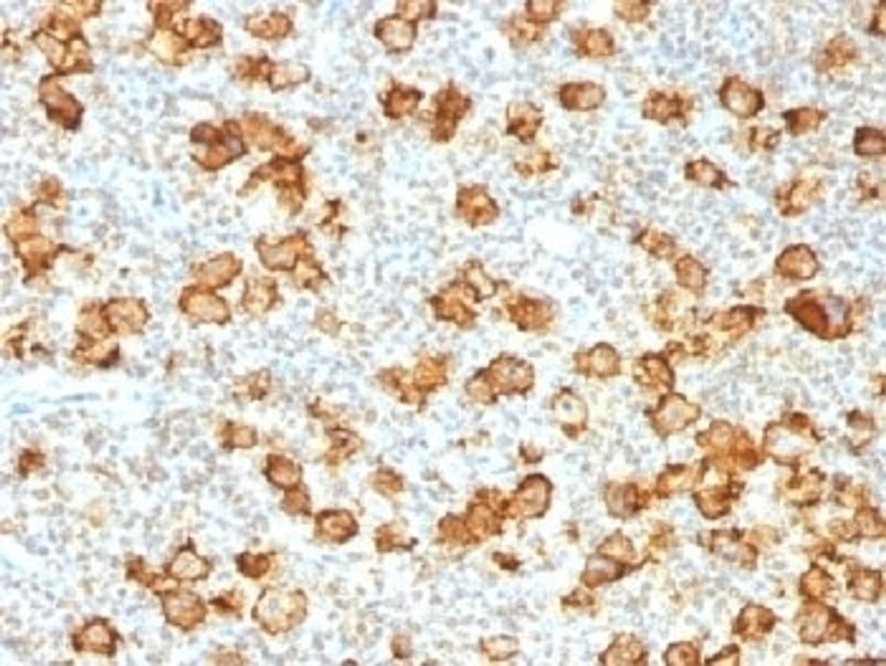 IHC testing of FFPE human Hodgkin's lymphoma stained with recombinant CD30 antibody (clone Ki-1/1505R) . Required HIER: steam sections in pH9, 1mM EDTA for 10-20 min.