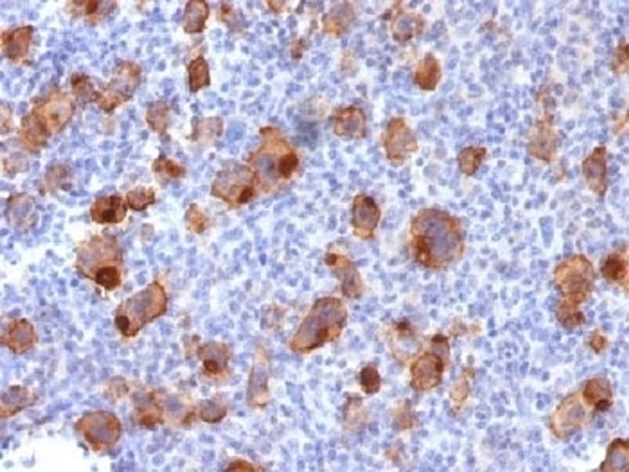 IHC testing of FFPE human Hodgkin's lymphoma stained with recombinant CD30 antibody (clone Ki-1/1747R) . Required HIER: steam sections in pH9, 1mM EDTA for 10-20 min.