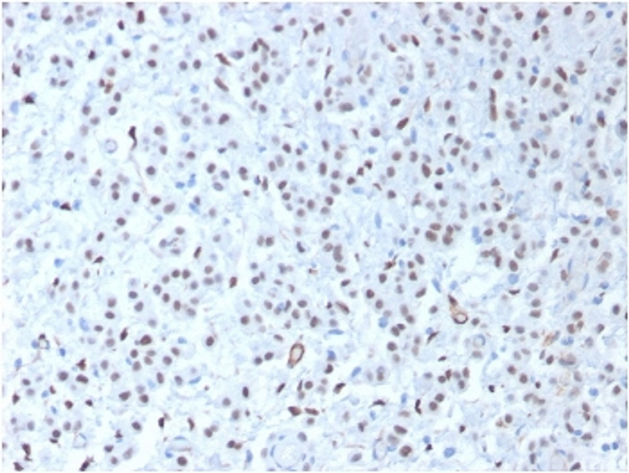 IHC testing of FFPE human mesothelioma tissue with recombinant WT1 antibody (clone WT1/1434R) . HIER: steam sections in 10mM citrate buffer, pH 6.0, for 10-20 min.