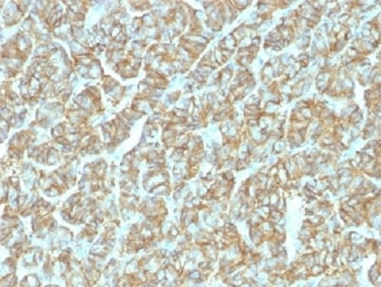 IHC testing of FFPE human thyroid carcinoma and recombinant EpCAM antibody (clone EGP40/1555R) . Required HIER: steam sections in pH6 citrate buffer for 10-20 min.