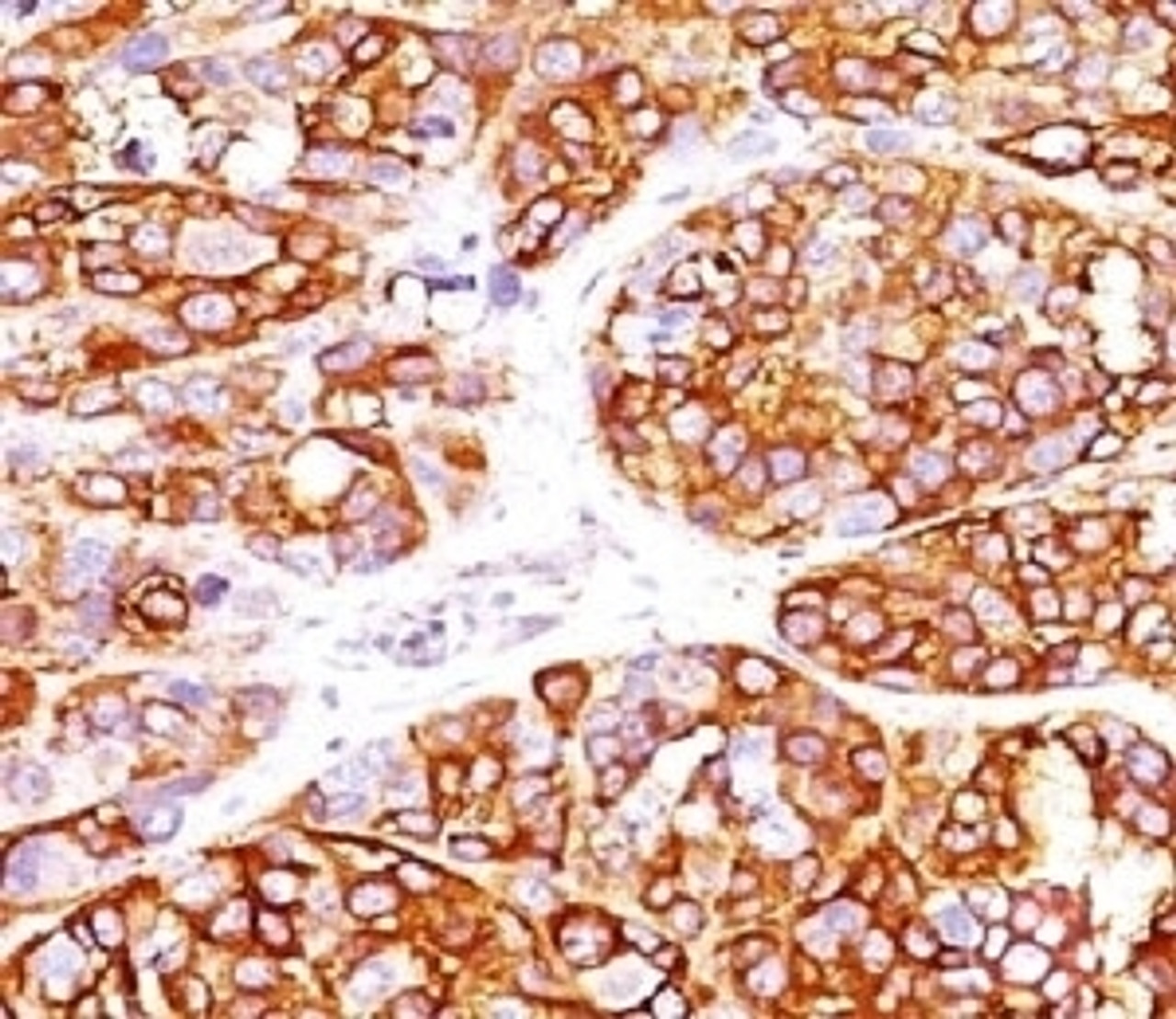 IHC testing of formalin-fixed, paraffin-embedded human melanoma stained with recombinant MART-1 antibody (clone MLANA/1409R) . HIER: steam sections in 10mM citrate buffer, pH 6.0, for 10-20 min.