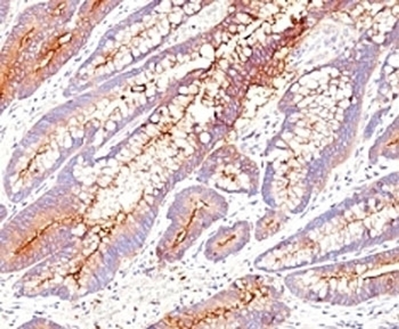 Formalin-fixed, paraffin-embedded human colon carcinoma stained with CEA antibody (SPM584) .