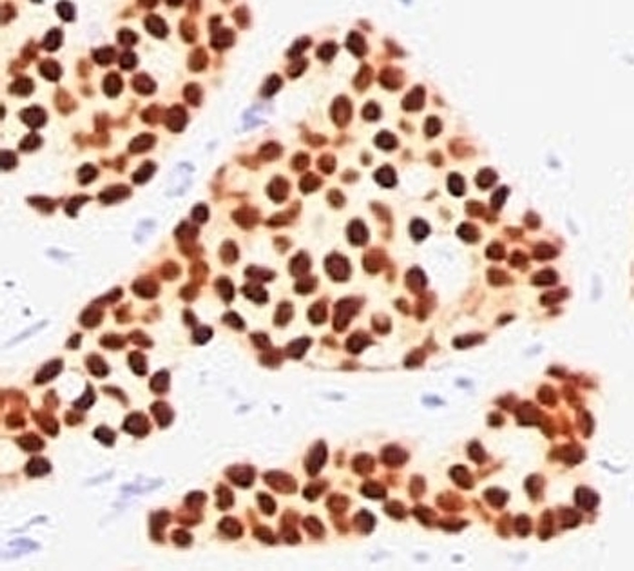 Formalin-fixed, paraffin-embedded human breast carcinoma stained with Estrogen Receptor antibody (SPM567) .
