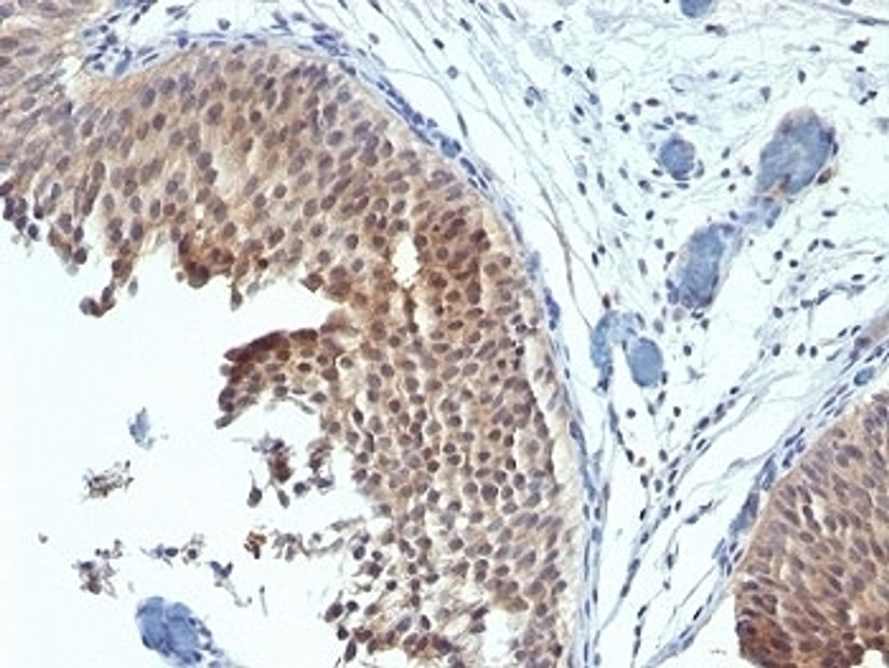 Formalin-fixed, paraffin-embedded human bladder carcinoma stained with Cytokeratin 6 antibody (SPM269)