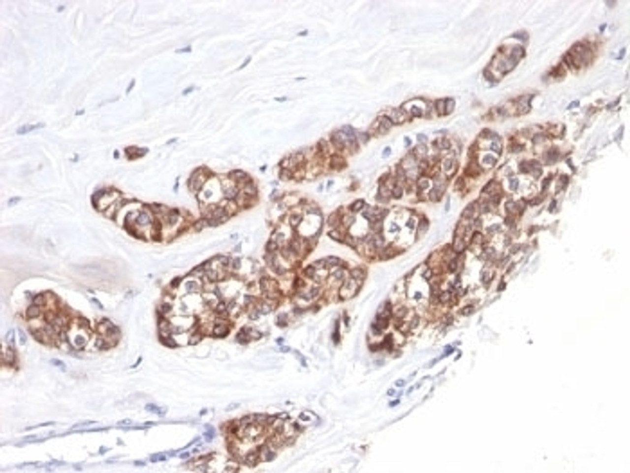 Formalin-fixed, paraffin-embedded human breast carcinoma stained with anti-Cytokeratin 18 antibody (SPM510) .