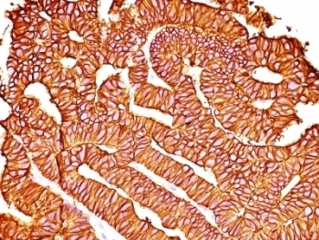 Formalin-fixed, paraffin-embedded human colon carcinoma stained with EpCAM antibody (SPM528) .
