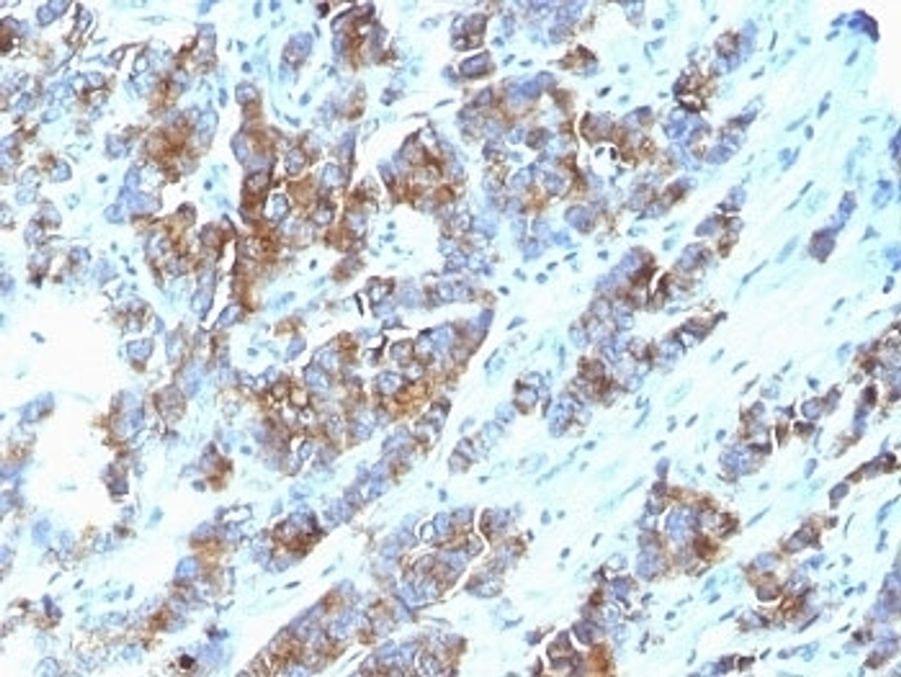 Formalin-fixed, paraffin-embedded human breast carcinoma stained with Mucin-1 antibody (SPM533) .