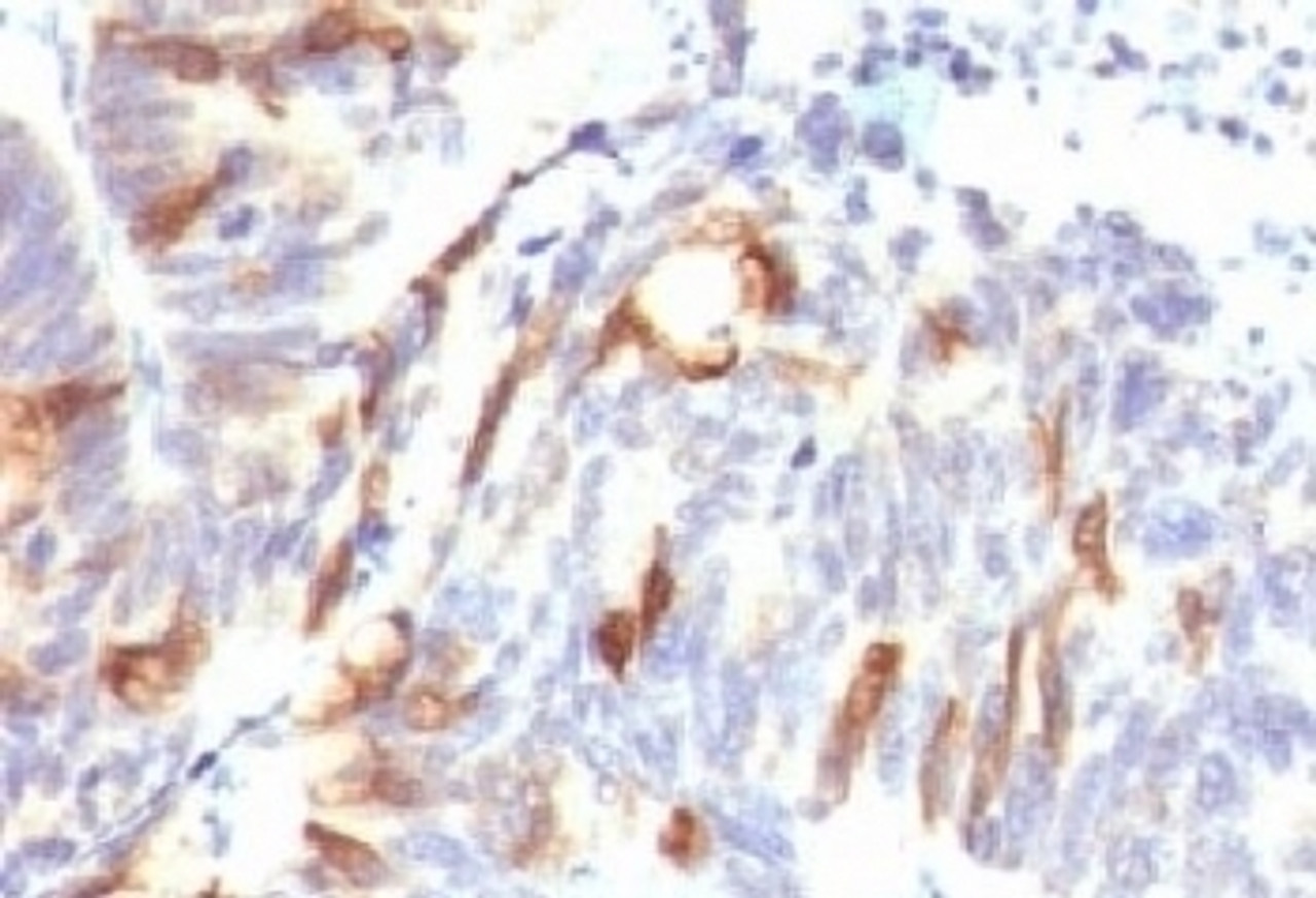 Formalin-fixed, paraffin-embedded human colon carcinoma stained with Mucin-2 antibody (SPM513) .