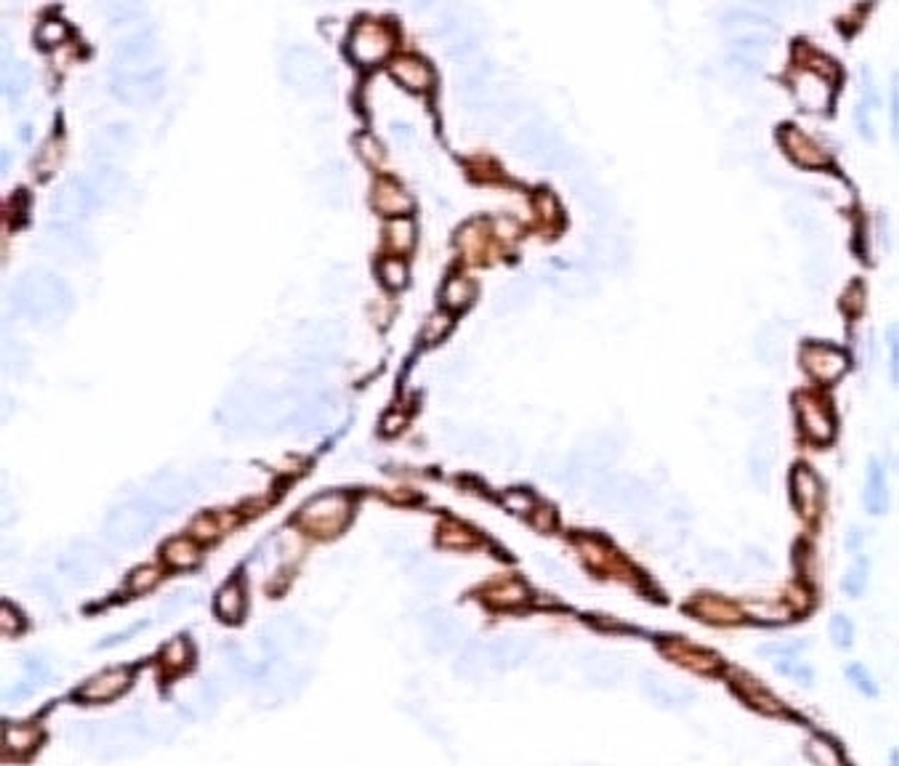 Formalin-fixed, paraffin-embedded human prostate carcinoma stained with anti-Cytokeratin 14 antibody (SPM263) .