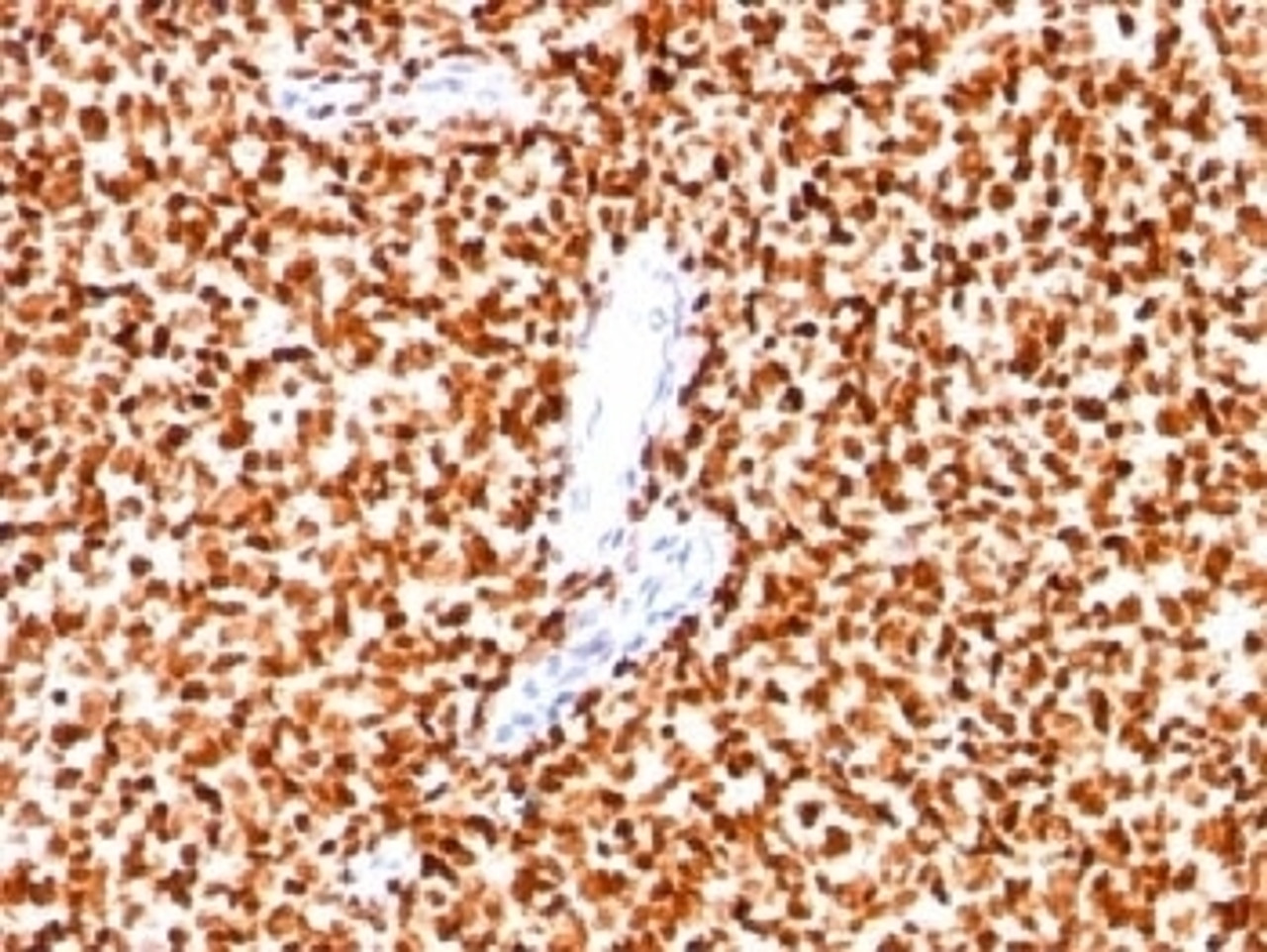 Formalin-fixed paraffin-embedded human Ewing's sarcoma stained with NKX2.2 antibody (SPM564) .