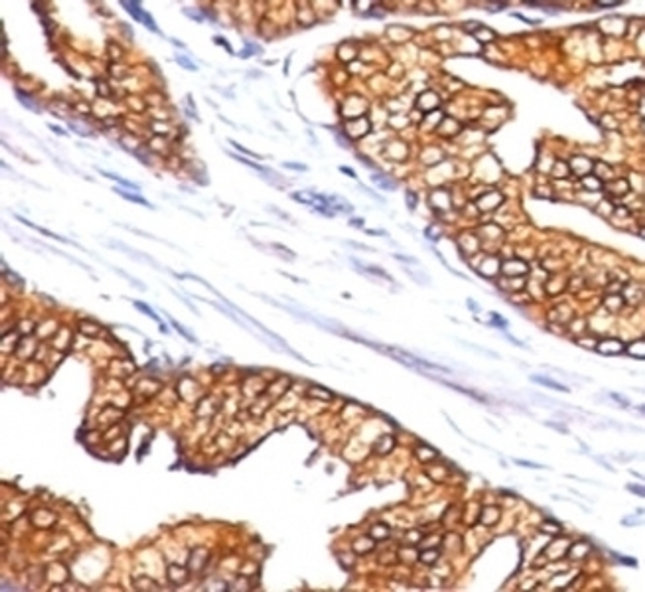 Formalin-fixed, paraffin-embedded human prostate carcinoma stained with ODC-1 antibody (SPM565)