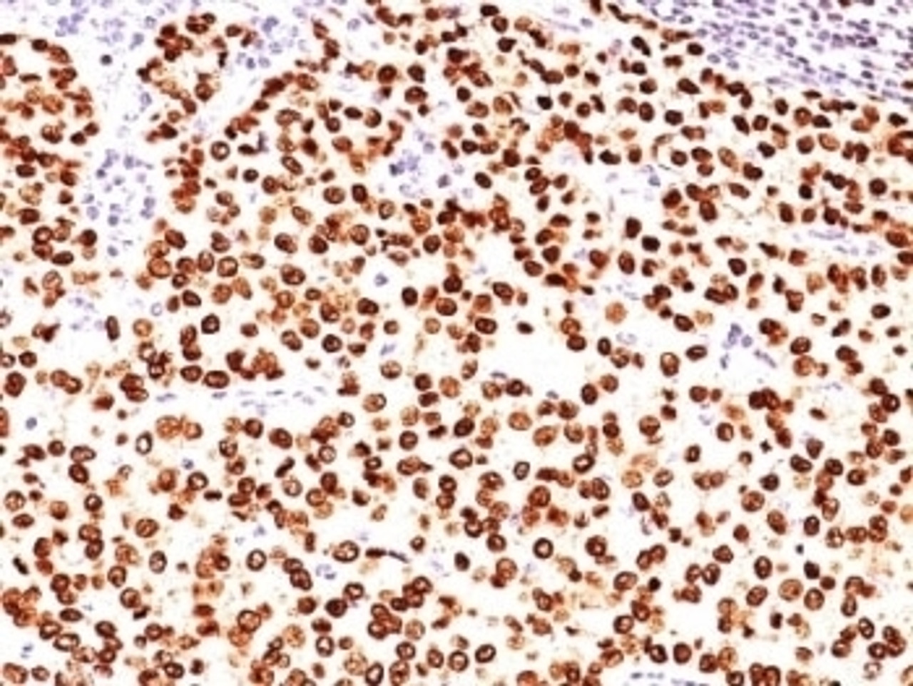 Formalin-fixed, paraffin-embedded human breast carcinoma stained with anti-Progesterone Receptor antibody (SPM566) .