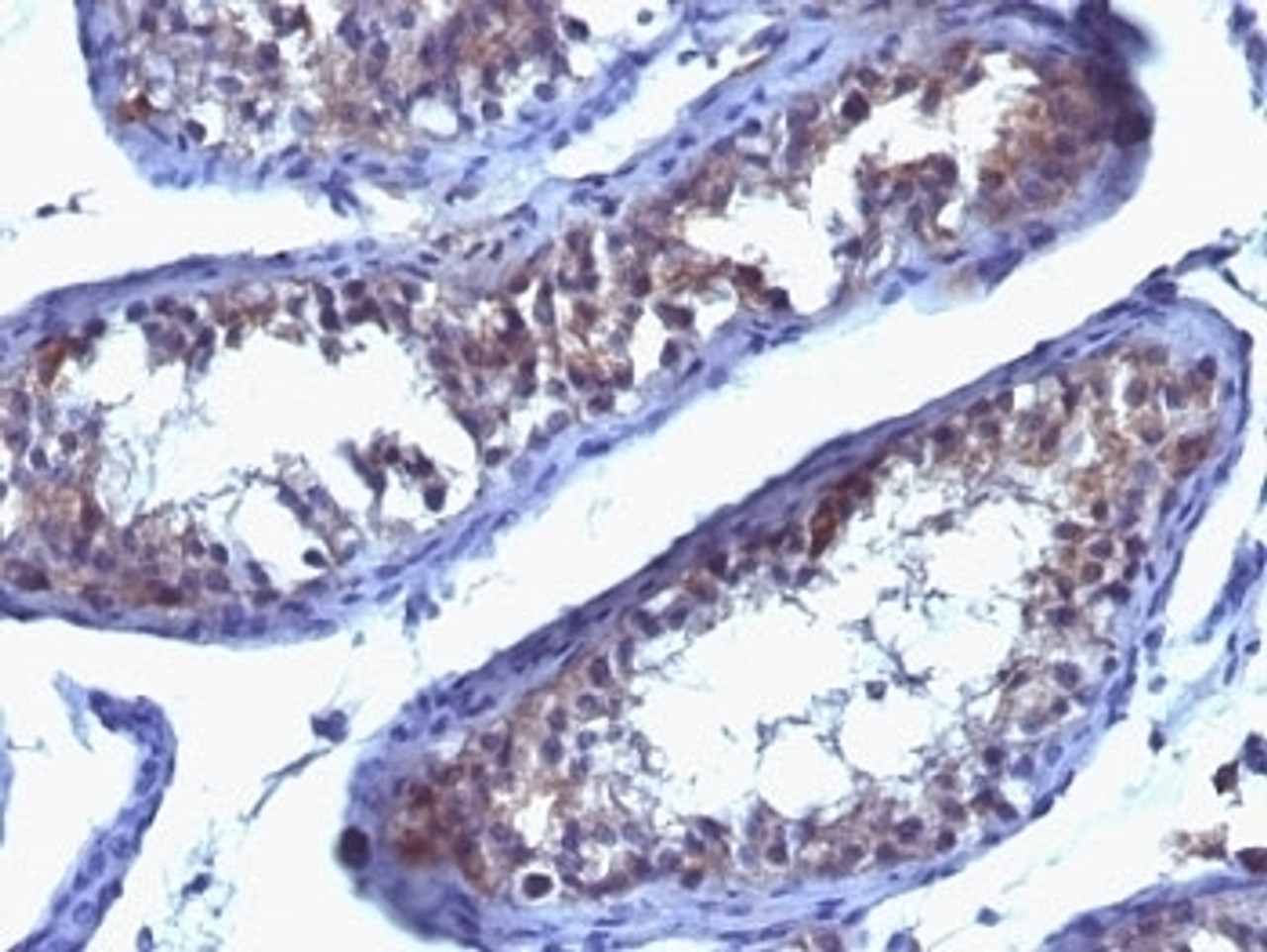 Formalin-fixed, paraffin-embedded human testicular carcinoma stained with anti-Prolactin Receptor antibody (SPM213) .
