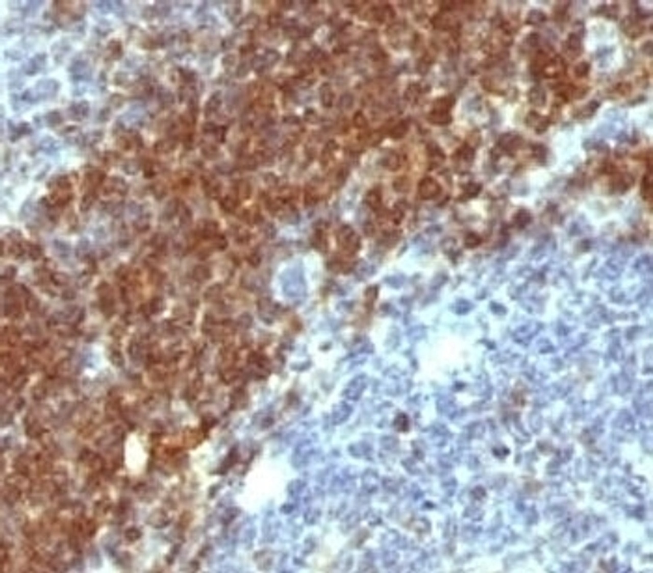 Formalin-fixed, paraffin-embedded human non-Hodgkin's lymphoma stained with anti-Bcl-2 antibody (SPM530) .