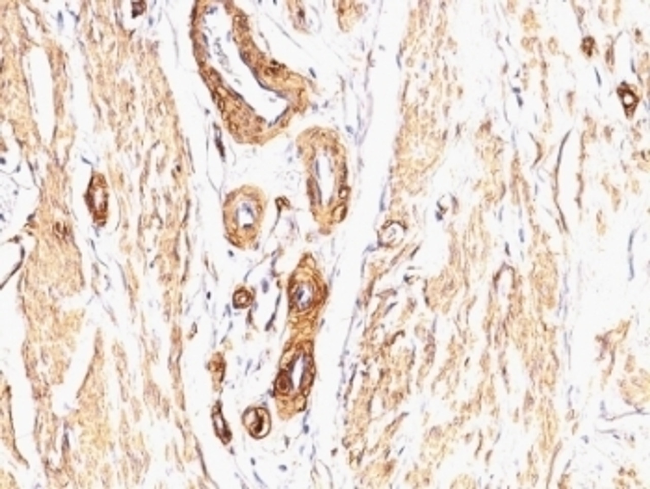 Formalin-fixed, paraffin-embedded Leiomyosarcoma stained with Smooth Muscle Actin antibody (SPM332) .