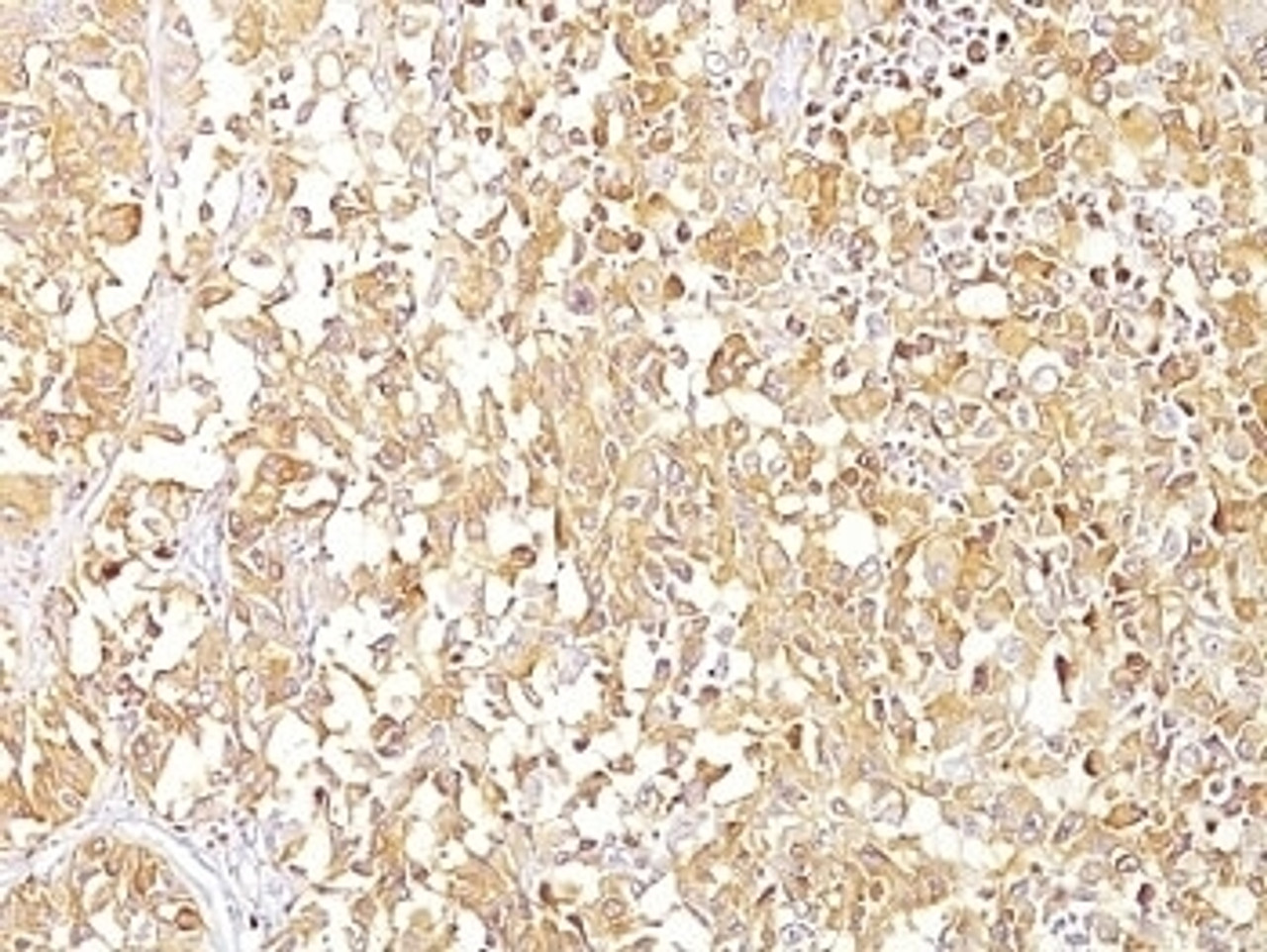 Formalin-fixed, paraffin-embedded human melanoma stained with gp100 antibody (SPM142) .