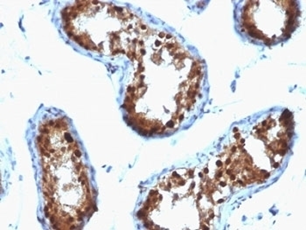 Formalin-fixed, paraffin-embedded human testicular carcinoma stained with SUMO-2/3 antibody (SPM572)
