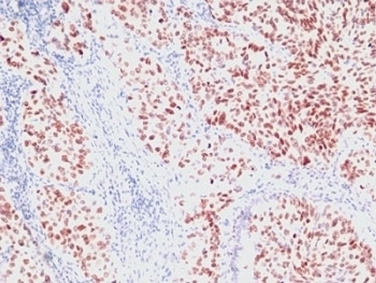 Formalin-fixed, paraffin-embedded human lung carcinoma stained with NKX2.1 antibody (SPM150)