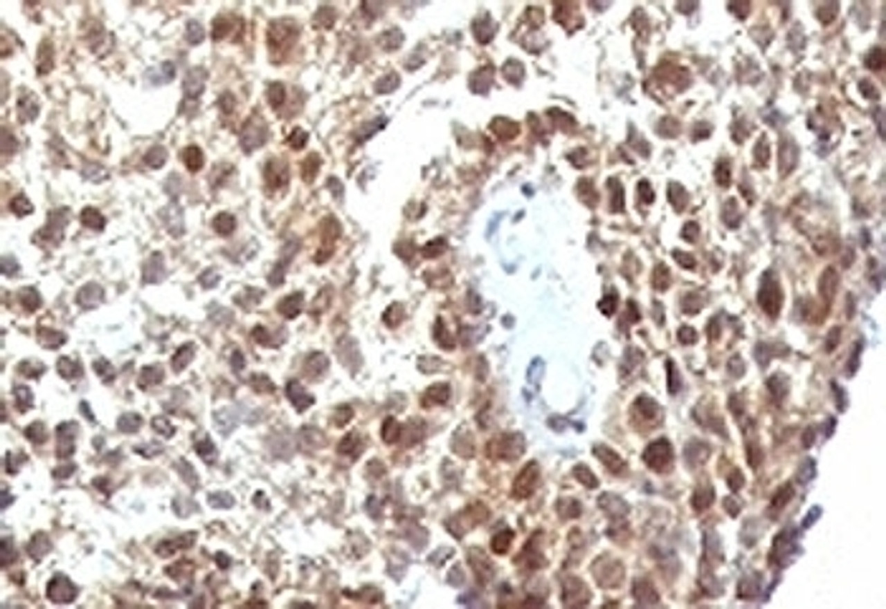 Formalin-fixed, paraffin-embedded human colon carcinoma stained with anti-p53 antibody (SPM590)