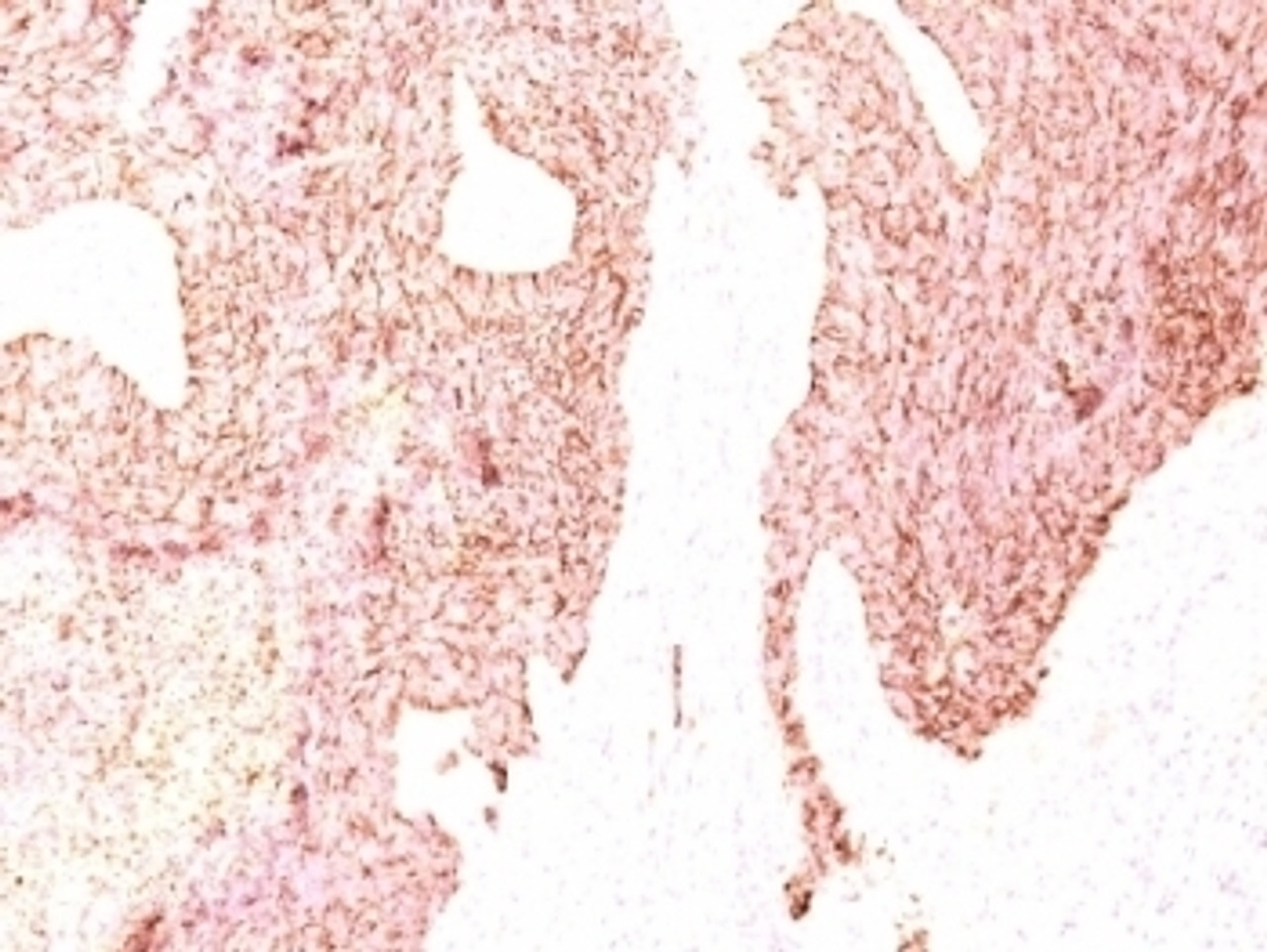 Formalin-fixed, paraffin-embedded human small cell lung carcinoma stained with Chromogranin A antibody (SPM339)