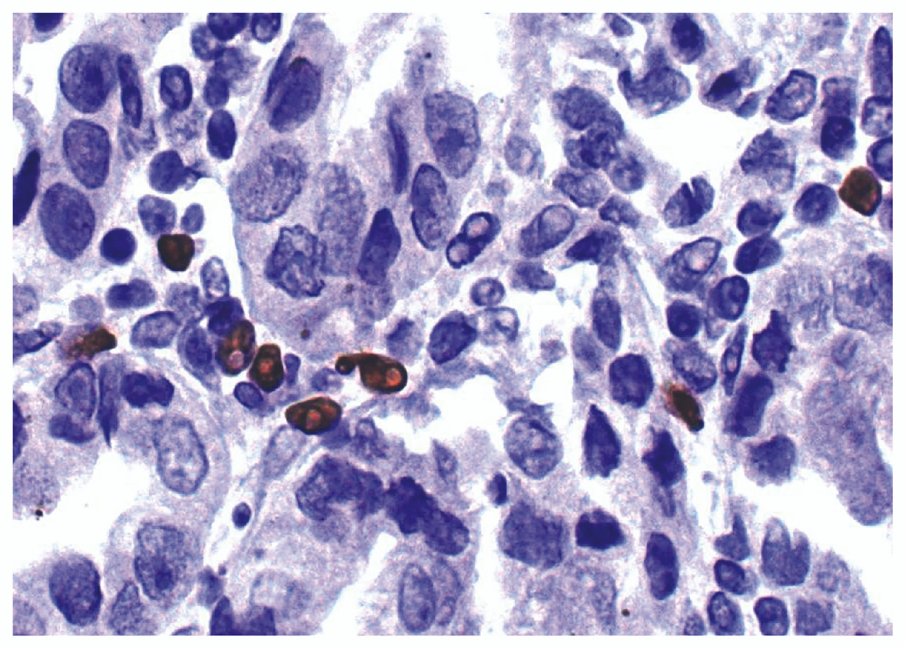 Human gastric cancer tissue was stained with Mouse Anti-Human Foxp3-UNLB (Cat. No. 99-788) followed by HRP conjugated Anti-Mouse Ig secondary antibody.