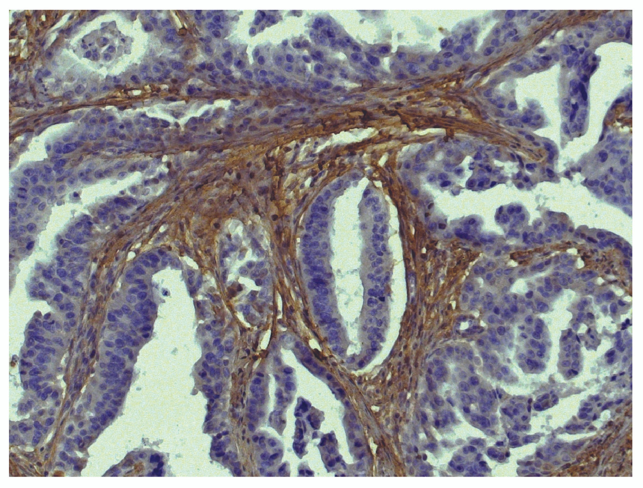 Paraffin embedded human gastric cancer tissue was stained with Goat Anti-Type I Collagen-BIOT (Cat. No. 98-502) followed by Streptavidin-HRP .