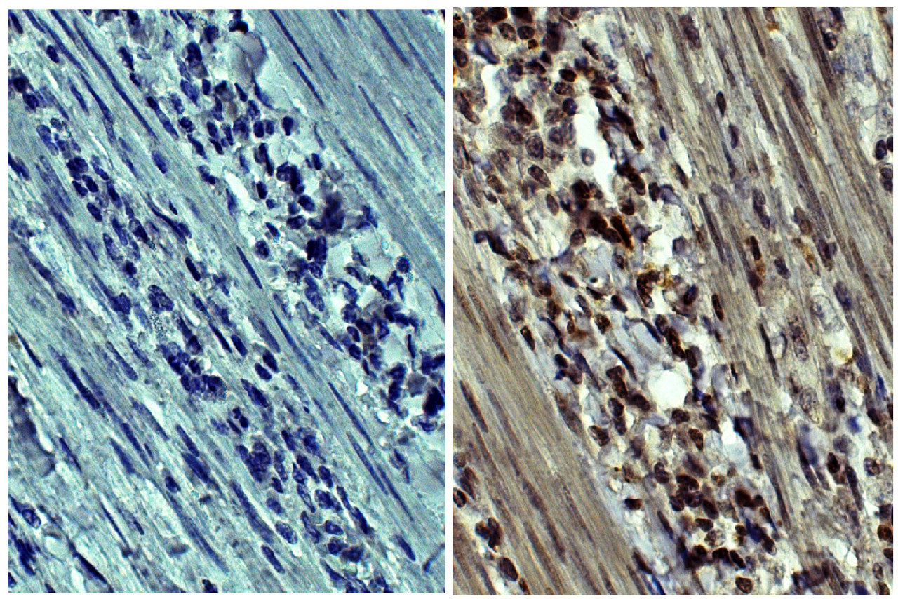 Human gastric cancer tissue was stained with Mouse IgG2a-HRP (Isotype Control; Cat. No. 0103-05) or Mouse Anti-Human MMP-9-HRP (Cat. No. 99-774) .