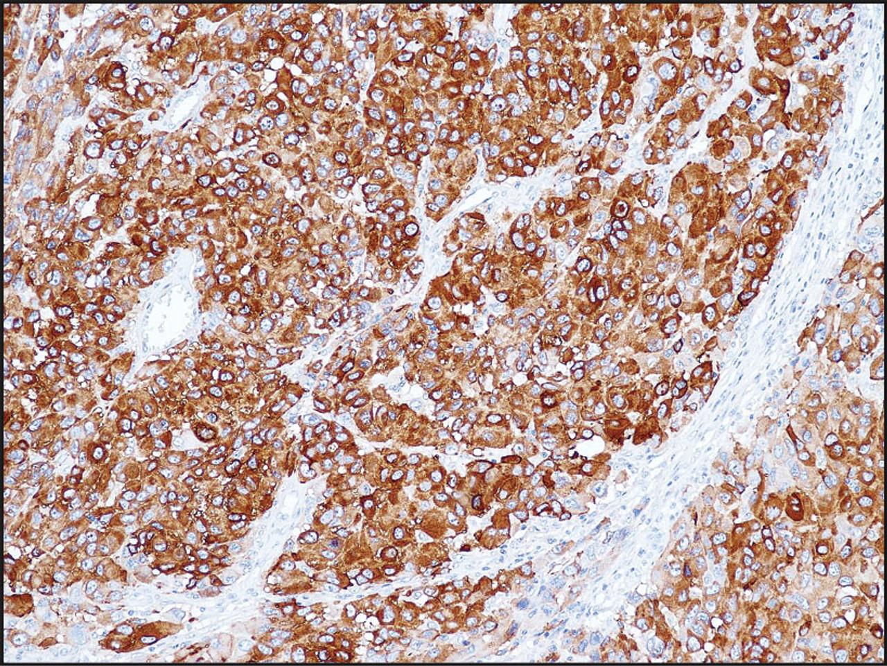 Immunohistochemistry staining of MLANA in human melanoma (4 microns) tissue using MLANA Antibody.