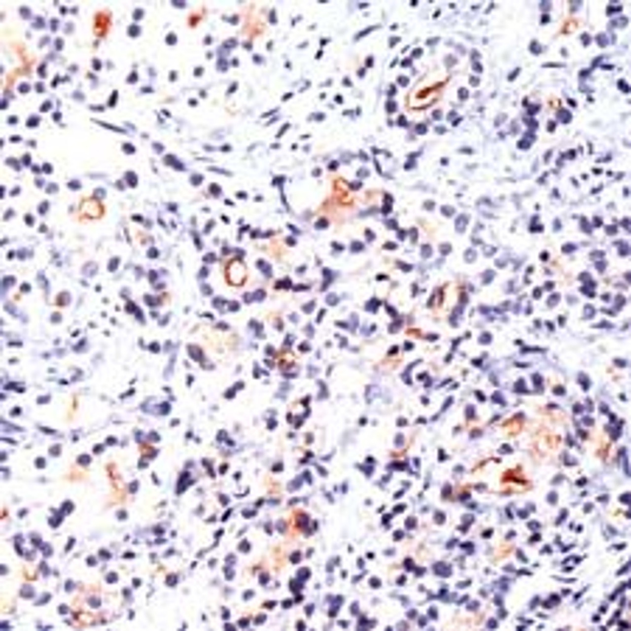 Immunohistochemistry staining of FOLH1 in human prostate carcinoma tissue using FOLH1 Antibody.